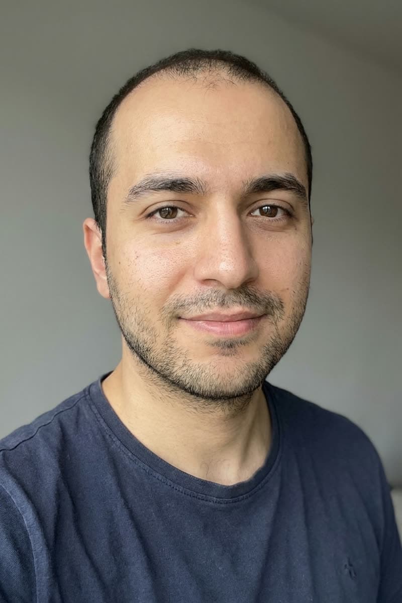 Haartransplantation vorher, Patient 2